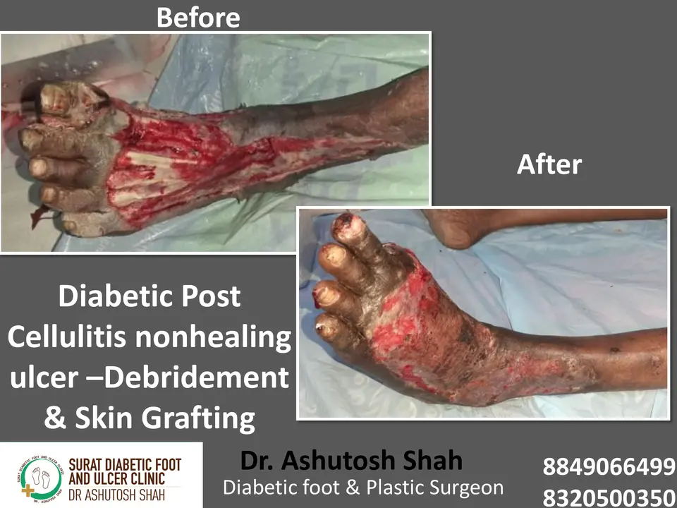 Diabetic Foot  PPT sunita.pptx-45.webp